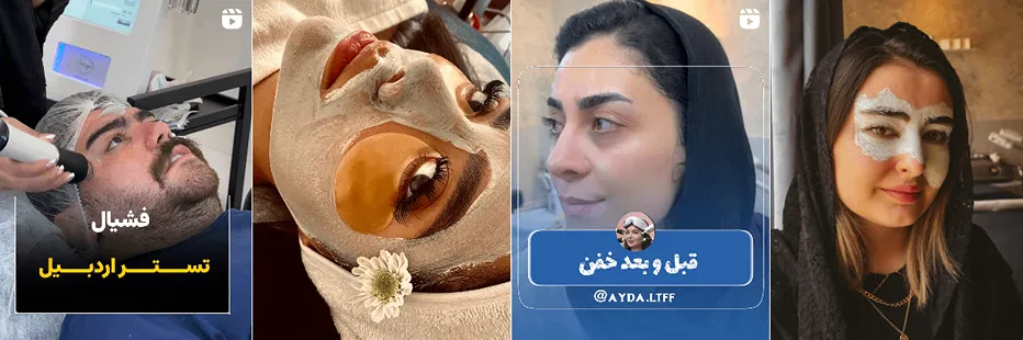 بهترین کلینیک و مرکز پاکسازی پوست در اردبیل(فیشیال)+ 1404