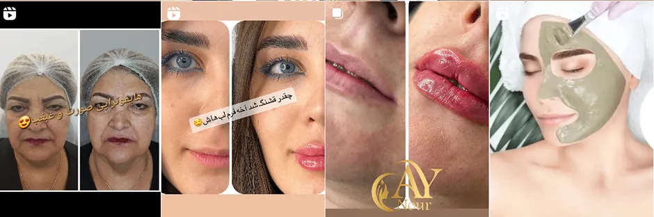 بهترین فیشال پوست در تبریز در کلینیک آی نور انجام میشود