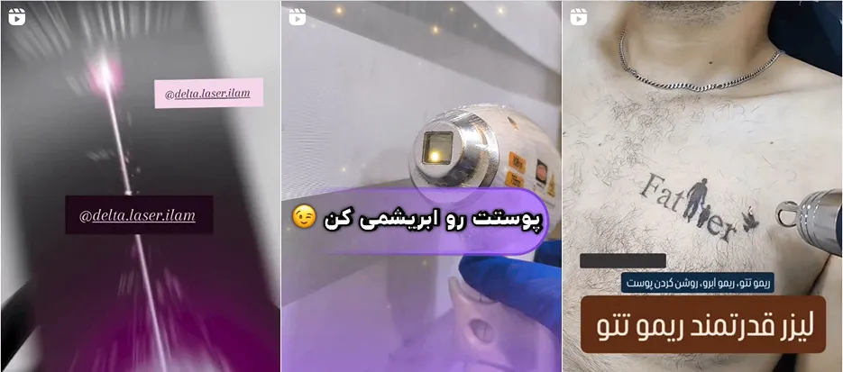 نمونه کار یکی از برترین کلینیک لیزر ایلام را مشاهده میفرمایید.