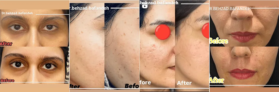 بهترین فیشال پوست در اهواز در کلینیک زیبایی دکتر بهزاد بافنده انجام میشود