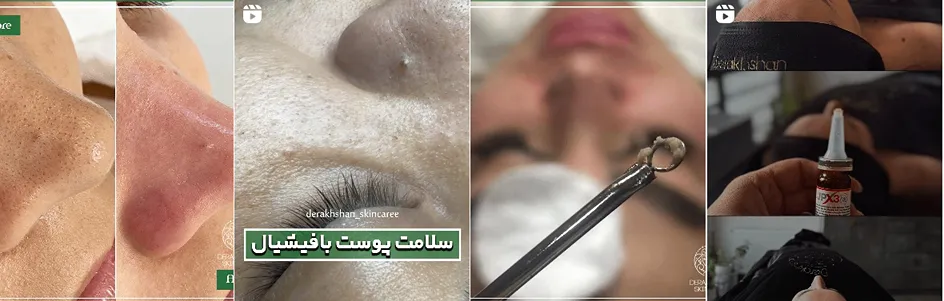 بهترین کلینیک و مرکز پاکسازی پوست در تبریز (فیشیال)+ 1404