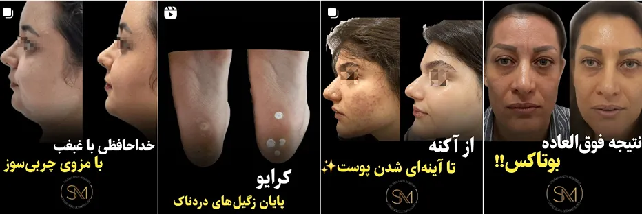 بهترین کلینیک و مرکز پاکسازی پوست در رشت (فیشیال)+ 1404