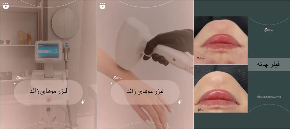 نمونه کار یکی از برترین کلینیک لیزر بجنورد را مشاهده میفرمایید.