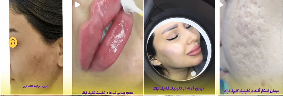 بهترین کلینیک و مرکز پاکسازی پوست در اراک(فیشیال)+ 1404