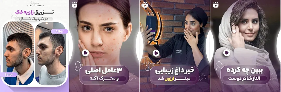 بهترین کلینیک و مرکز پاکسازی پوست در ساری(فیشیال)+ 1404