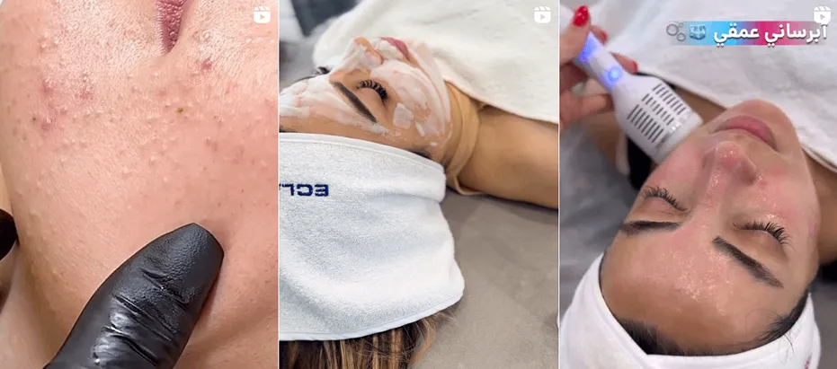 بهترین مرکز فیشیال در کرج توسظ ارزو رحیمی انجام میشود.