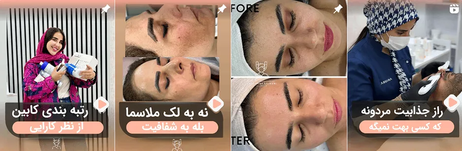 بهترین کلینیک و مرکز پاکسازی پوست در اردبیل(فیشیال)+ 1404