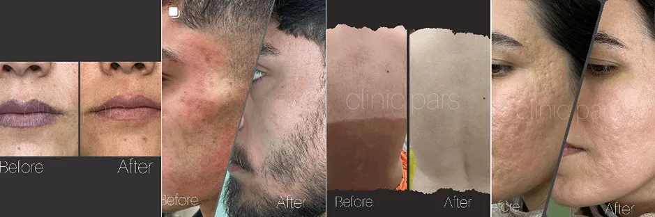 بهترین کلینیک و مرکز پاکسازی پوست در همدان (فیشیال)+ 1404