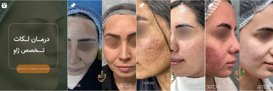 بهترین کلینیک و مرکز پاکسازی پوست در قزوین(فیشیال)+ 1404