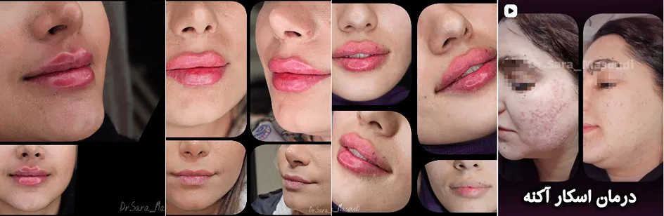 بهترین کلینیک و مرکز پاکسازی پوست در کاشان(فیشیال)+ 1404