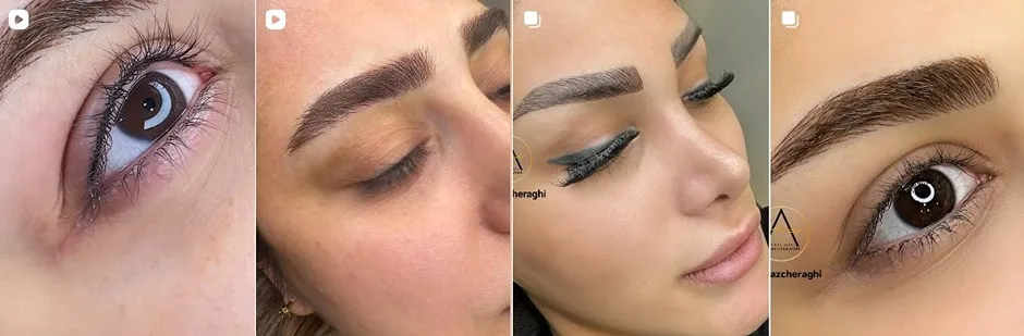 معرفی کامل بهترین مرکز فیبروز ابرو در تهران 1404