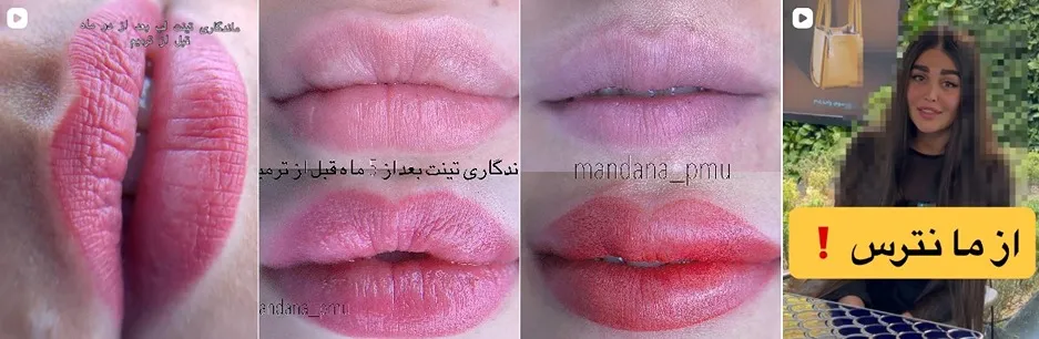 معرفی کامل بهترین مرکز شیدینگ لب در تهران 1404